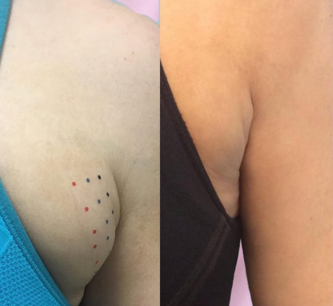 Liquid Lipo/Meso Theapry Sessions